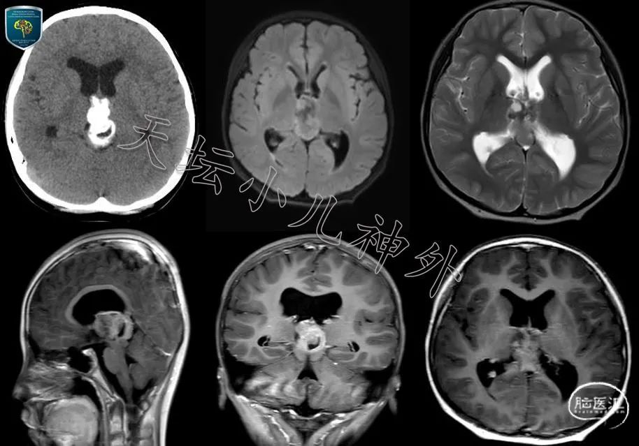 宫剑教授病例分享202115罕见病一例儿童三室内室管膜瘤的诊疗体会兼论