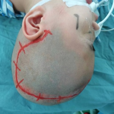杭州市儿童医院神经外科应用peek材料修补重度颅脑损伤术后颅骨缺损