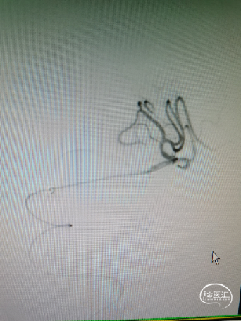 trevo 4mm*20mm取栓支架