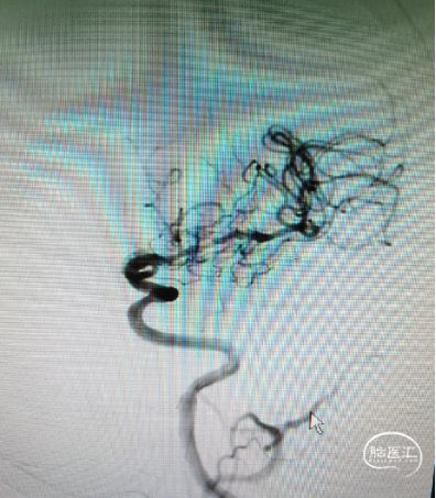 trevo 4mm*20mm取栓支架