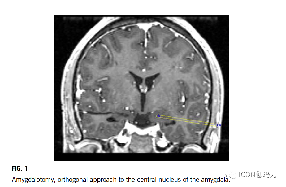 病理切片快递怎么包装【文献快递】手术或伽玛刀毁损治疗难治自闭症攻击性或强迫症行为_https://www.jmylbn.com_新闻资讯_第2张