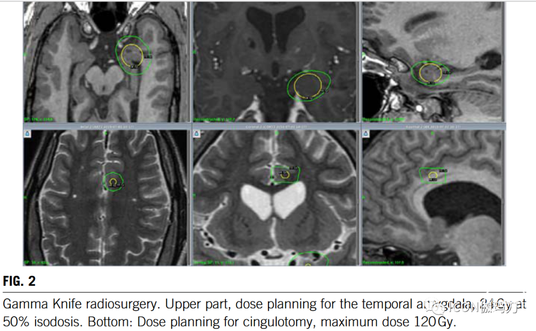 病理切片快递怎么包装【文献快递】手术或伽玛刀毁损治疗难治自闭症攻击性或强迫症行为_https://www.jmylbn.com_新闻资讯_第3张