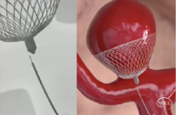 contour辅助弹簧圈栓塞治疗宽颈颅内动脉瘤的良好闭塞率研究原理和