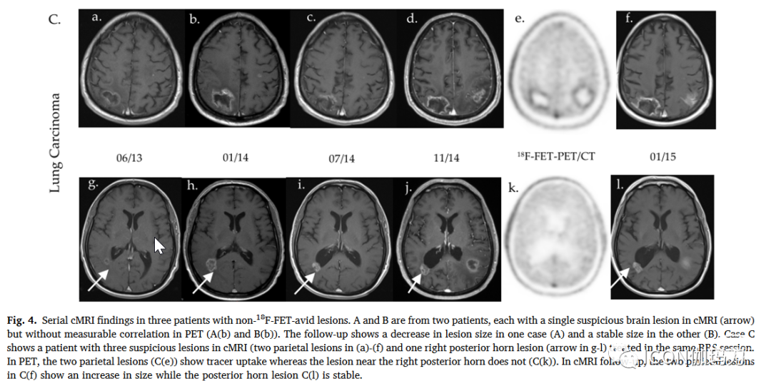【文献快递】动态18F - FET PET/CT鉴别原发性脑肿瘤和脑转移瘤复发与单次机器人放射外科治疗后的放射性坏死 - 脑医汇