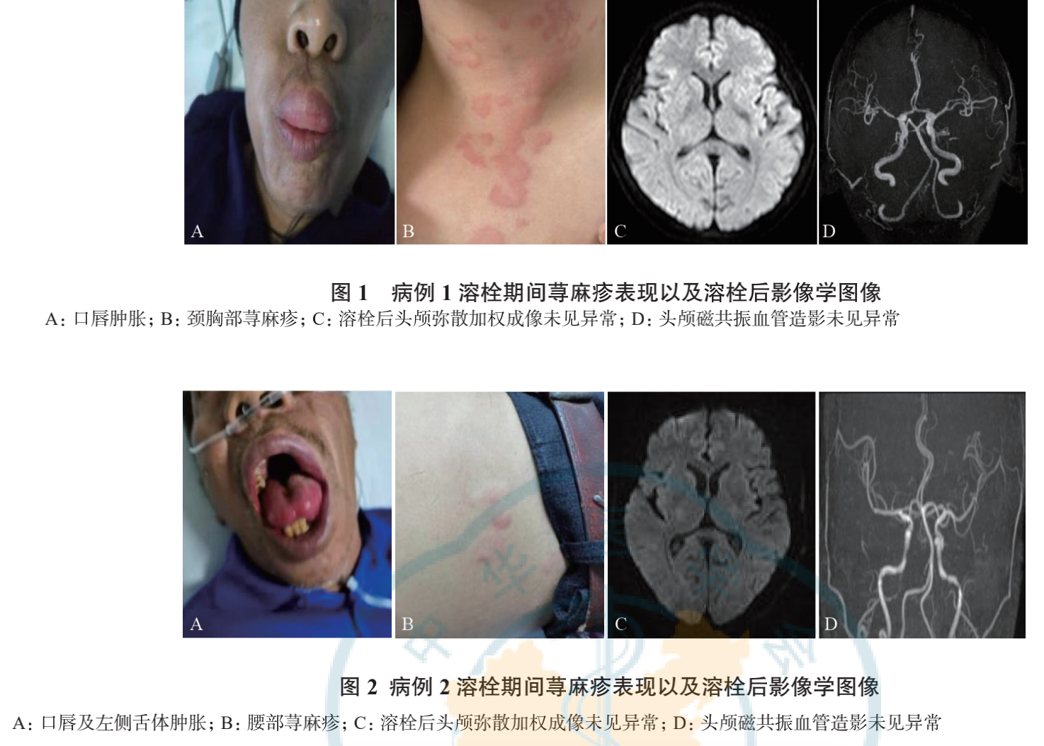 血管性水肿-皮肤性病-医学