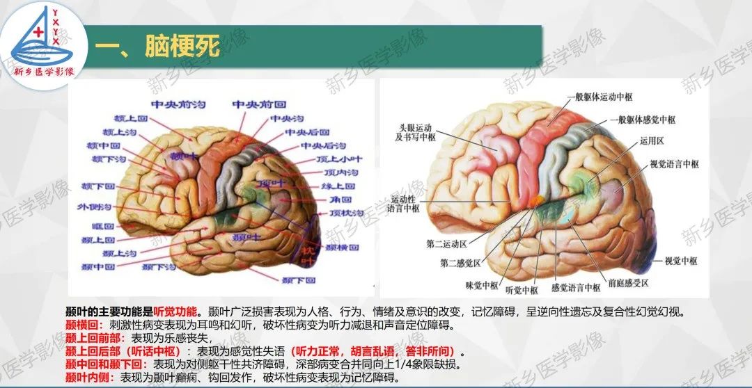 赞 脑梗死责任血管定位