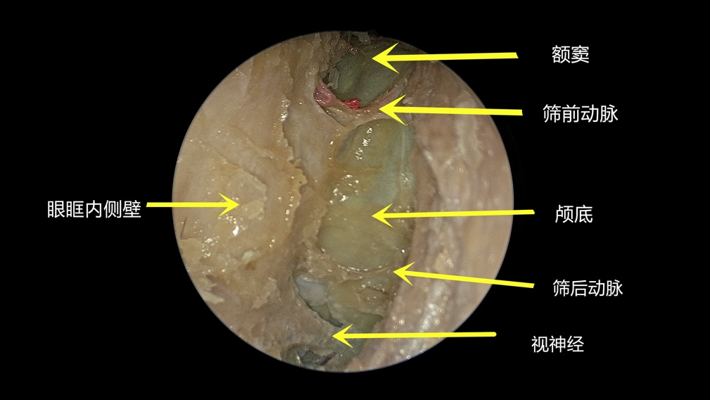 前床突磨除及海绵窦解剖kawase入路及海绵窦解剖乙状窦后入路解剖声明
