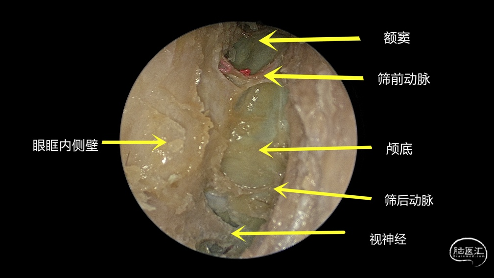 内镜下筛前筛后动脉解剖面神经的解剖豆纹动脉解剖岛叶解剖前床突磨除