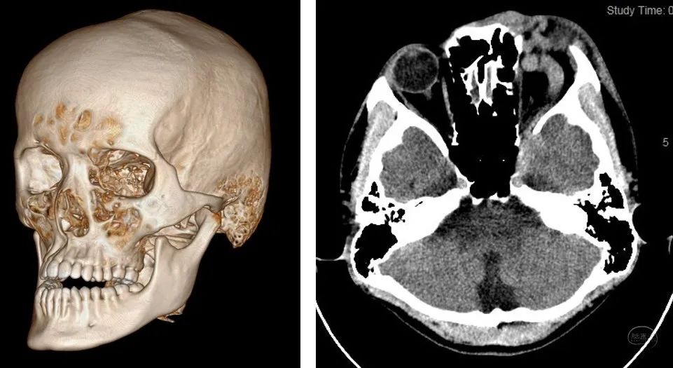 颅骨三维重建未见明确的骨折线,但ct提示左侧眼静脉迂曲怒张,如下图