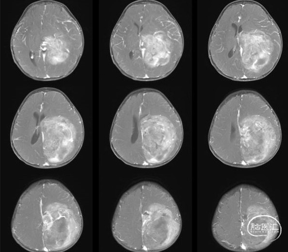 左側額頂枕葉巨大混雜信號腫塊伴瘤內出血,呈明顯不均勻強化:原始神經