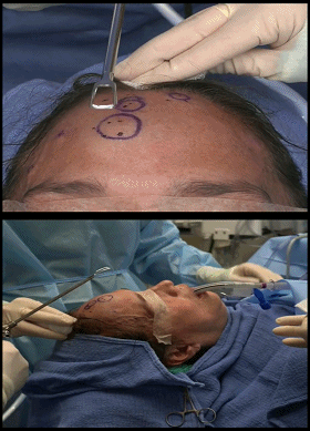 额头骨瘤手术费用图片