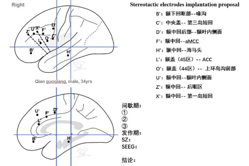 龚德山教授团队:岛叶难治性癫痫病例分享 - 脑医汇