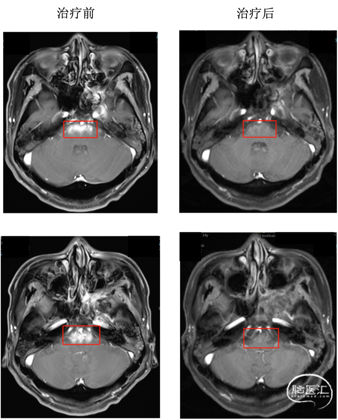 影像基础：MRI颅脑冠状位解剖图谱