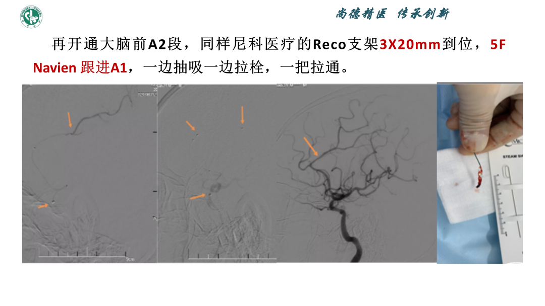 小血管血栓取栓病例_05.png