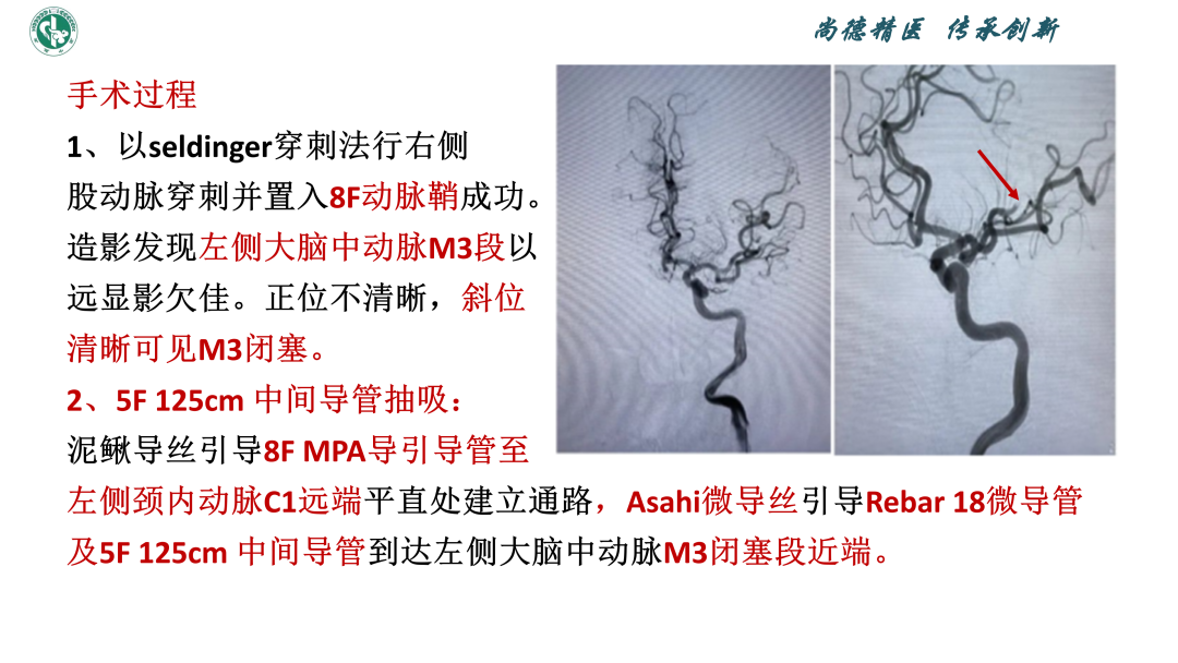 小血管血栓取栓病例_11.png