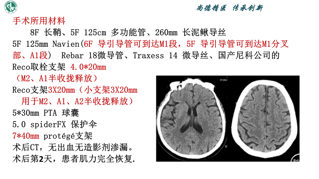 小血管血栓取栓病例_07.png