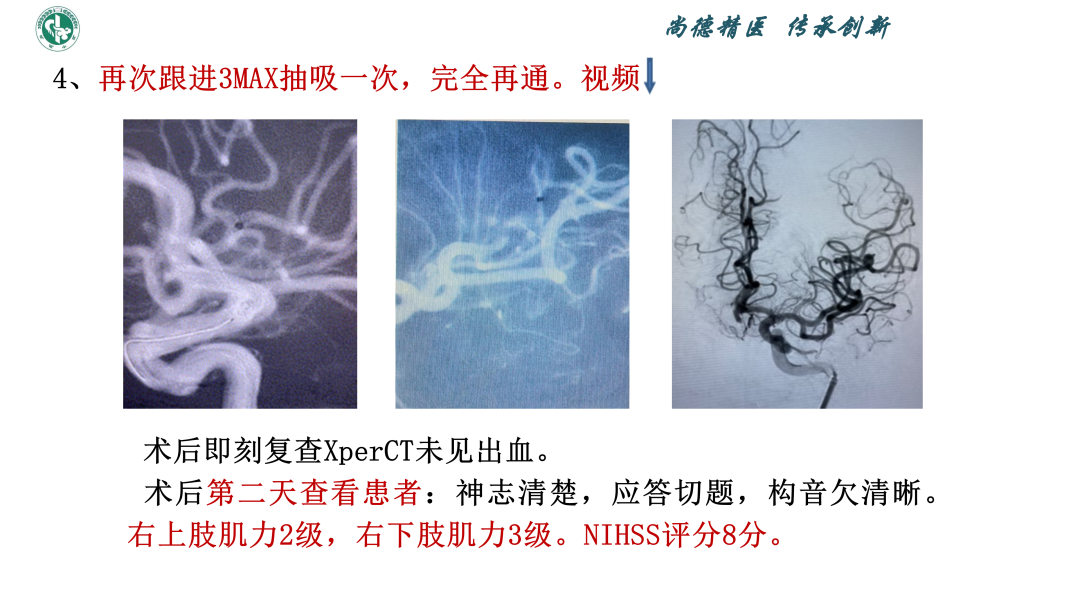 小血管血栓取栓病例_14.png