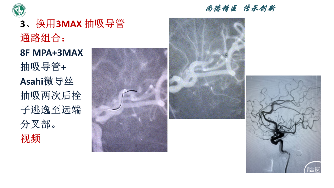 小血管血栓取栓病例_13.png