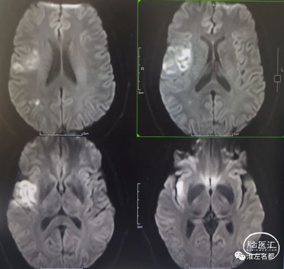 右侧大脑中动脉闭塞血管内治疗一例 - 脑医汇 - 神外资讯 - 神介资讯