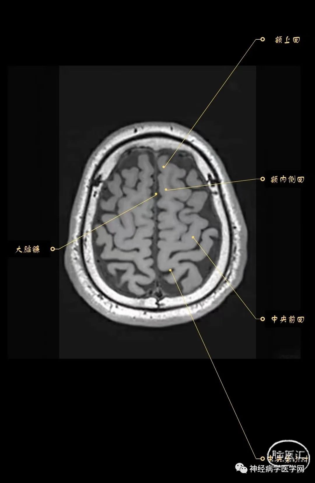 高清颅脑MRI最全轴位影像解剖 - 脑医汇