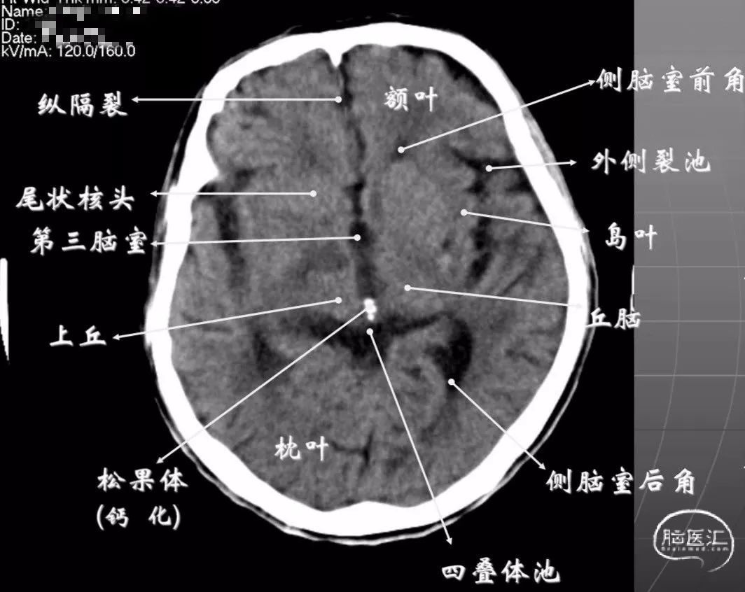 中枢神经系统疾病定位诊断图解——脑桥的解剖生理及定位诊断 - 脑医汇 - 神外资讯 - 神介资讯