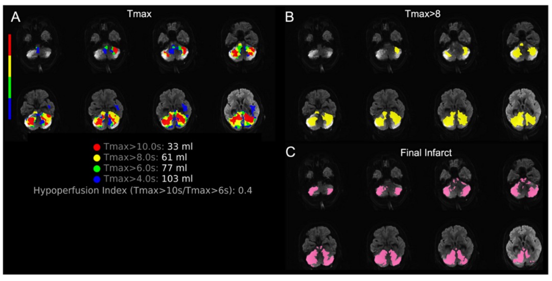 脑灌注成像评估基底动脉取栓术后患者最终梗死体积 - 脑医汇 - 神外资讯 - 神介资讯