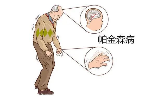 后,就开始出现"手抖"的症状,拇指与屈曲的食指间不断呈"搓丸样"动作