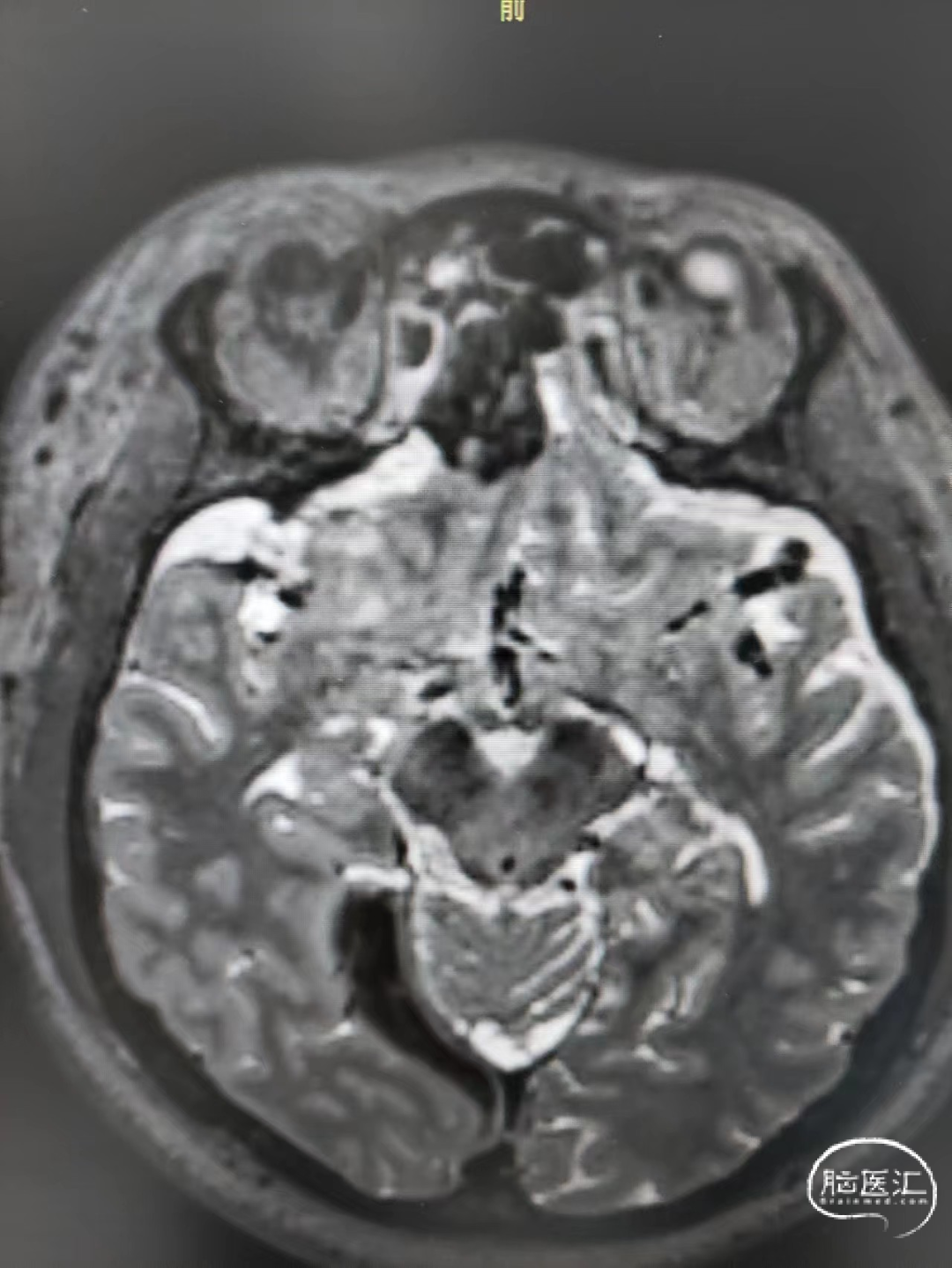 Nature Reviews Neurology：从影像学角度了解脊髓损伤病理 - 知乎