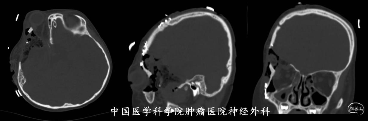 术后复查CT骨窗合图