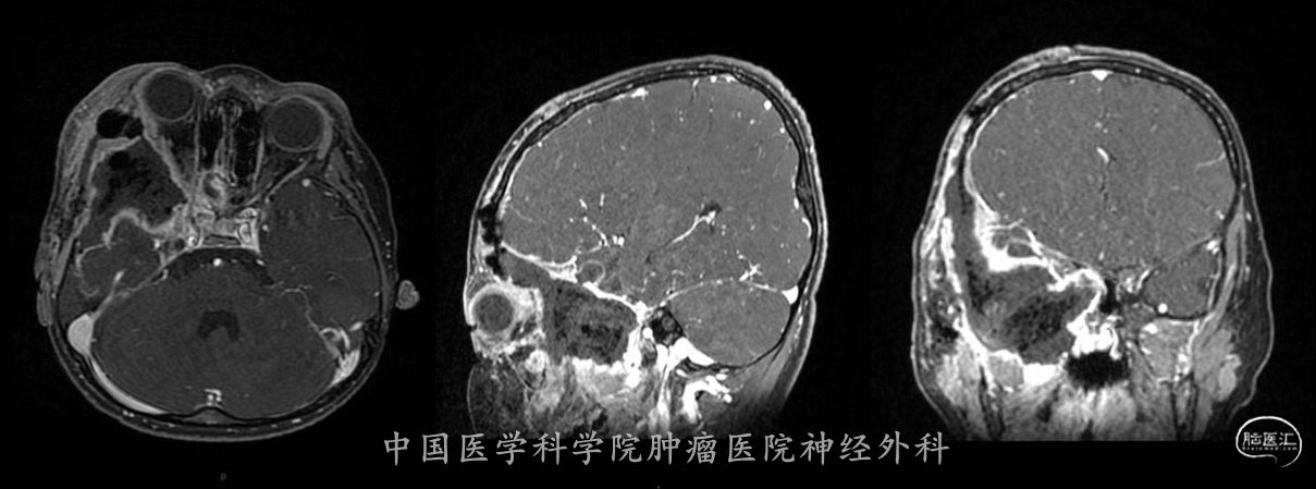 术后MRI增强合成