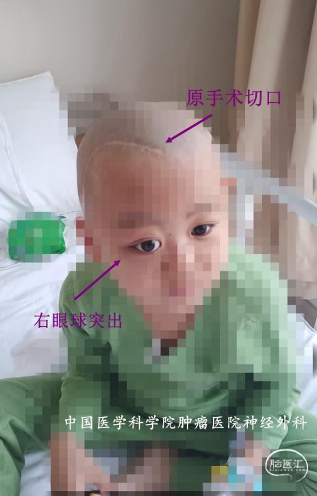 右眼球突出（修改后）