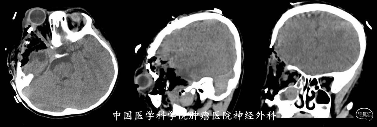 术后复查CT脑窗合图