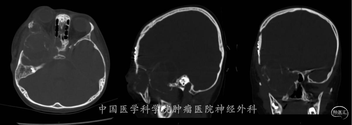 术前CT骨窗合图