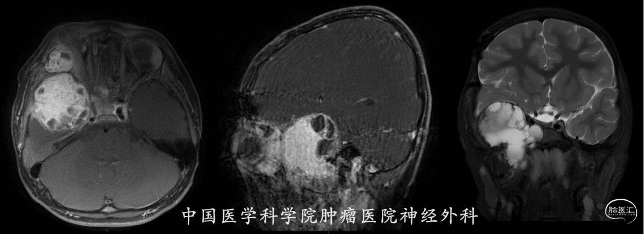 术前MRI合图
