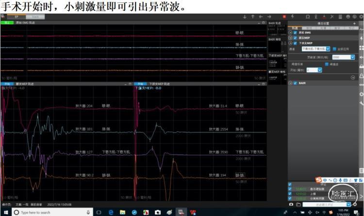 简篇-价值病例9：面肌痉挛术后复发患者再手术成功治愈