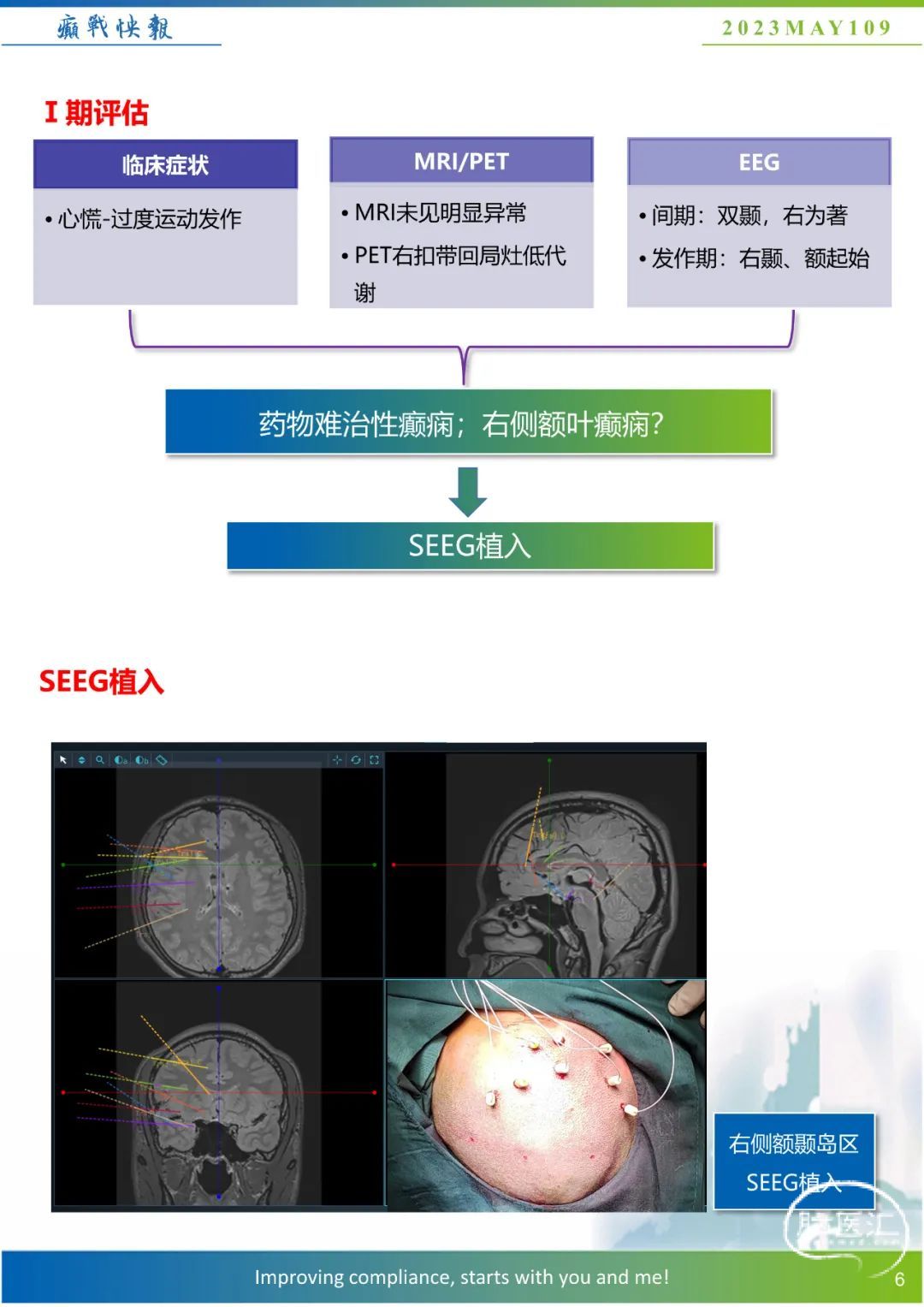 【癫战快报】第109期:SEEG引导下皮层电刺激辅助定位致痫灶一例 - 脑医汇