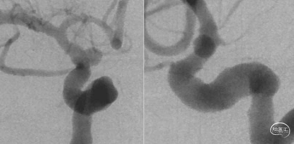 【OCIN CASES】教学病例-28:FD结合弹簧圈治疗破裂急性期的血泡样动脉瘤 - 脑医汇 - 神外资讯 - 神介资讯