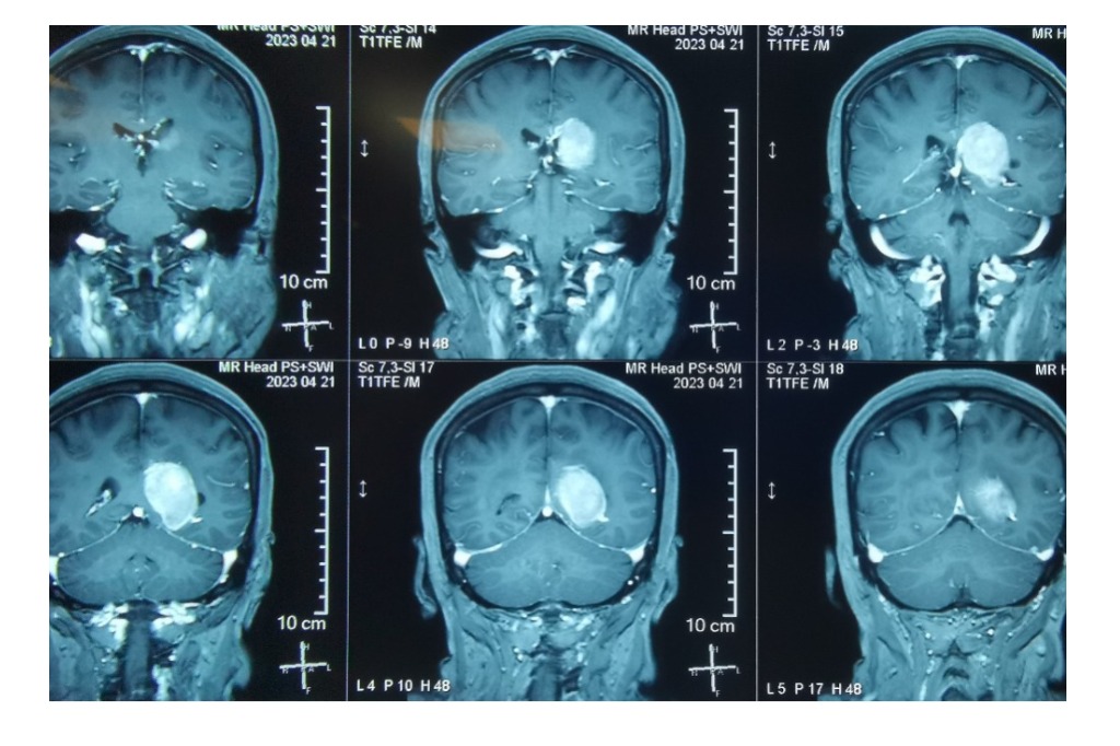 神经内镜通道下经右侧纵裂、大脑镰、左侧楔前叶切除脑室三角区脑膜瘤