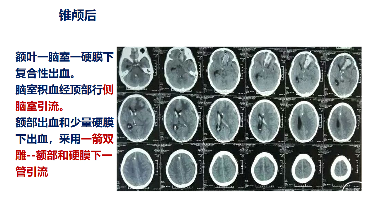 脑出血微创锥颅引流技术(2).png