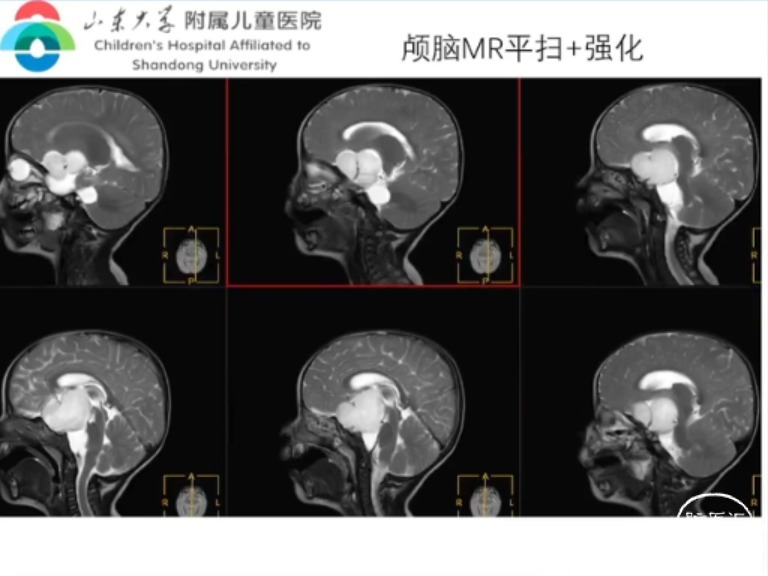 脑医汇_中华医学会2023小儿神经外科学术会议 - 小儿视路胶质瘤单中心综合治疗经验 - 脑医汇 - 神外资讯 - 神介资讯_1689324709115.png