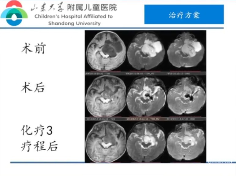 脑医汇_中华医学会2023小儿神经外科学术会议 - 小儿视路胶质瘤单中心综合治疗经验 - 脑医汇 - 神外资讯 - 神介资讯_1689323427912.png