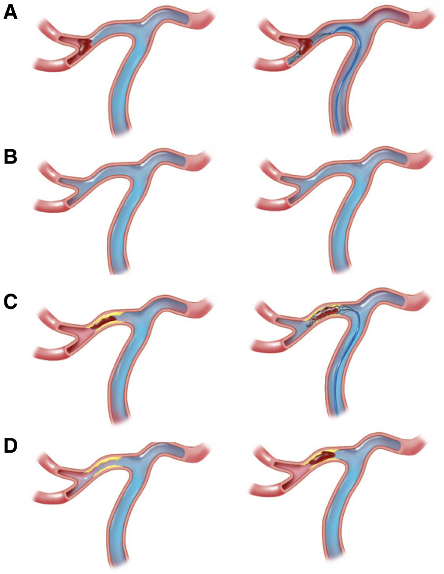 Stroke:ICAS大血管闭塞性卒中的识别、药物和介入治疗以及结局(二) - 脑医汇