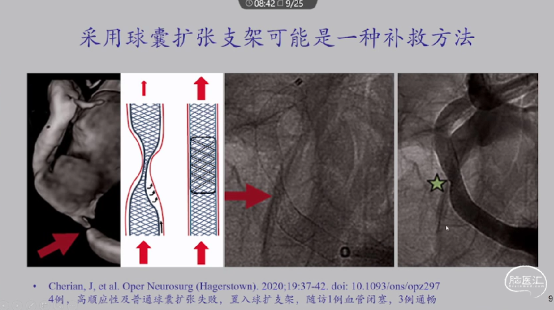 洪波教授:血流导向装置治疗颅内动脉瘤的一些难点问题 - 脑医汇