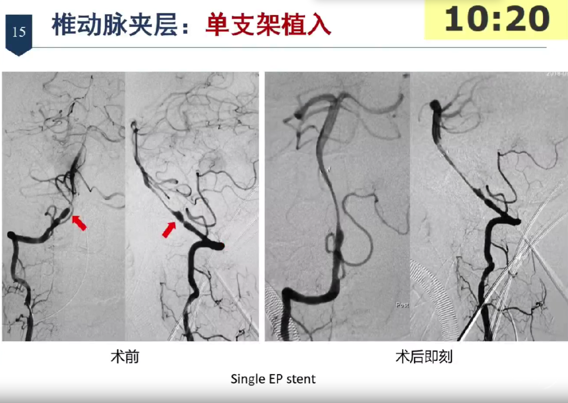 朱悦琦教授:颅内段椎动脉夹层动脉瘤的血管内治疗 - 脑医汇