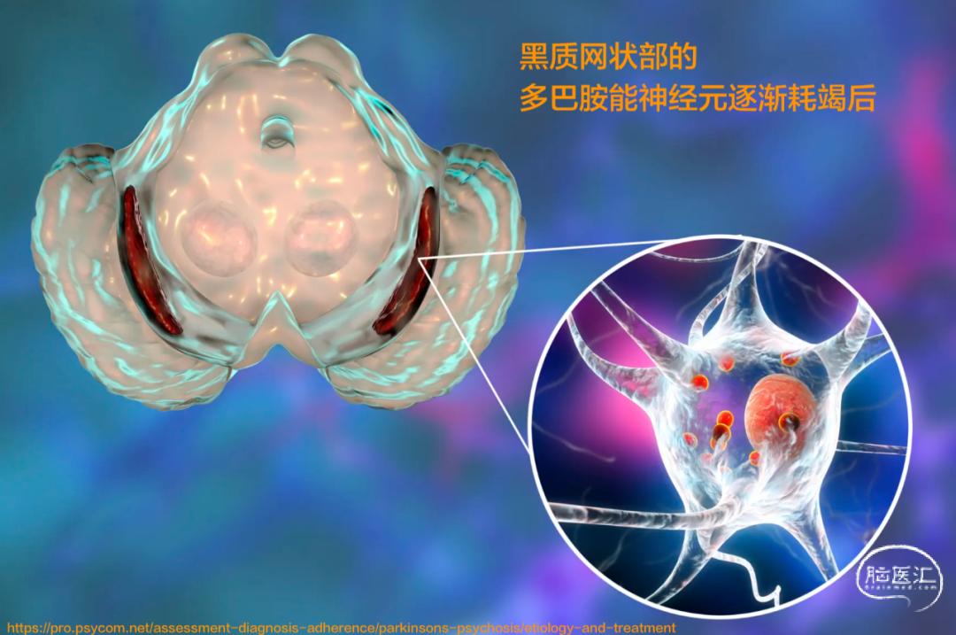 极简医学——帕金森病的诊断 - 脑医汇