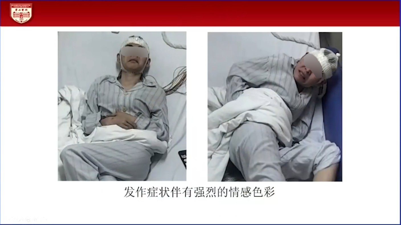 胡杰教授:起源于额上回癫痫发作的临床特点及致痫网络 脑医汇 神外资讯 神介资讯
