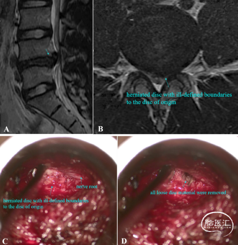 腰椎间盘突出的新型MRI分类法指导个体化治疗策略