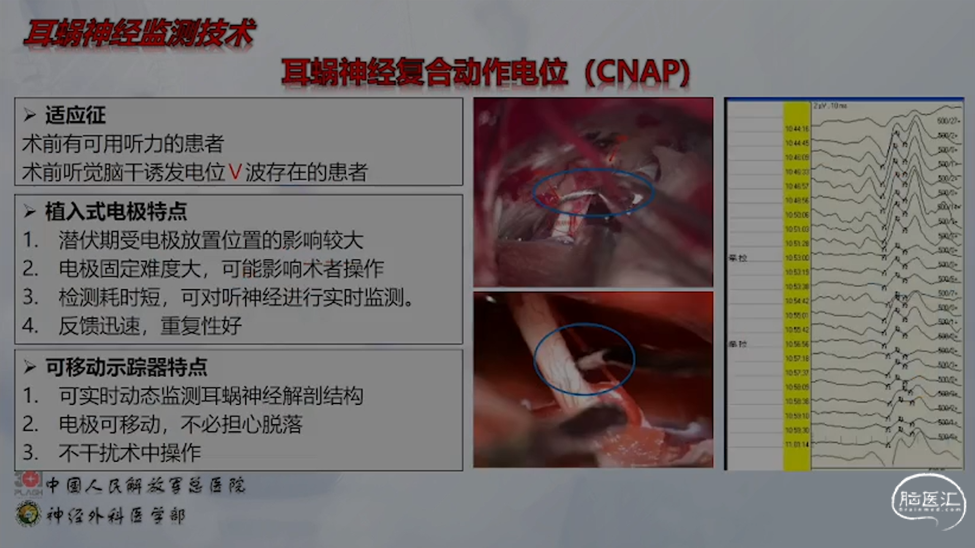 第一期：楼美清教授——研微听神经瘤 - 脑医汇 - 神外资讯 - 神介资讯