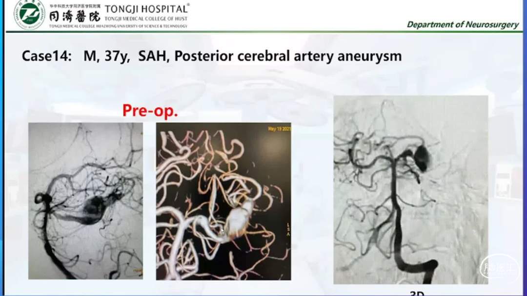 朱明欣教授:endovascular rx of posterior circle dissecting