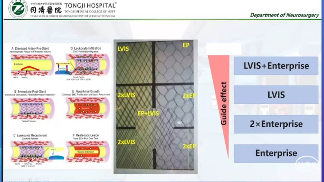 朱明欣教授:endovascular rx of posterior circle dissecting